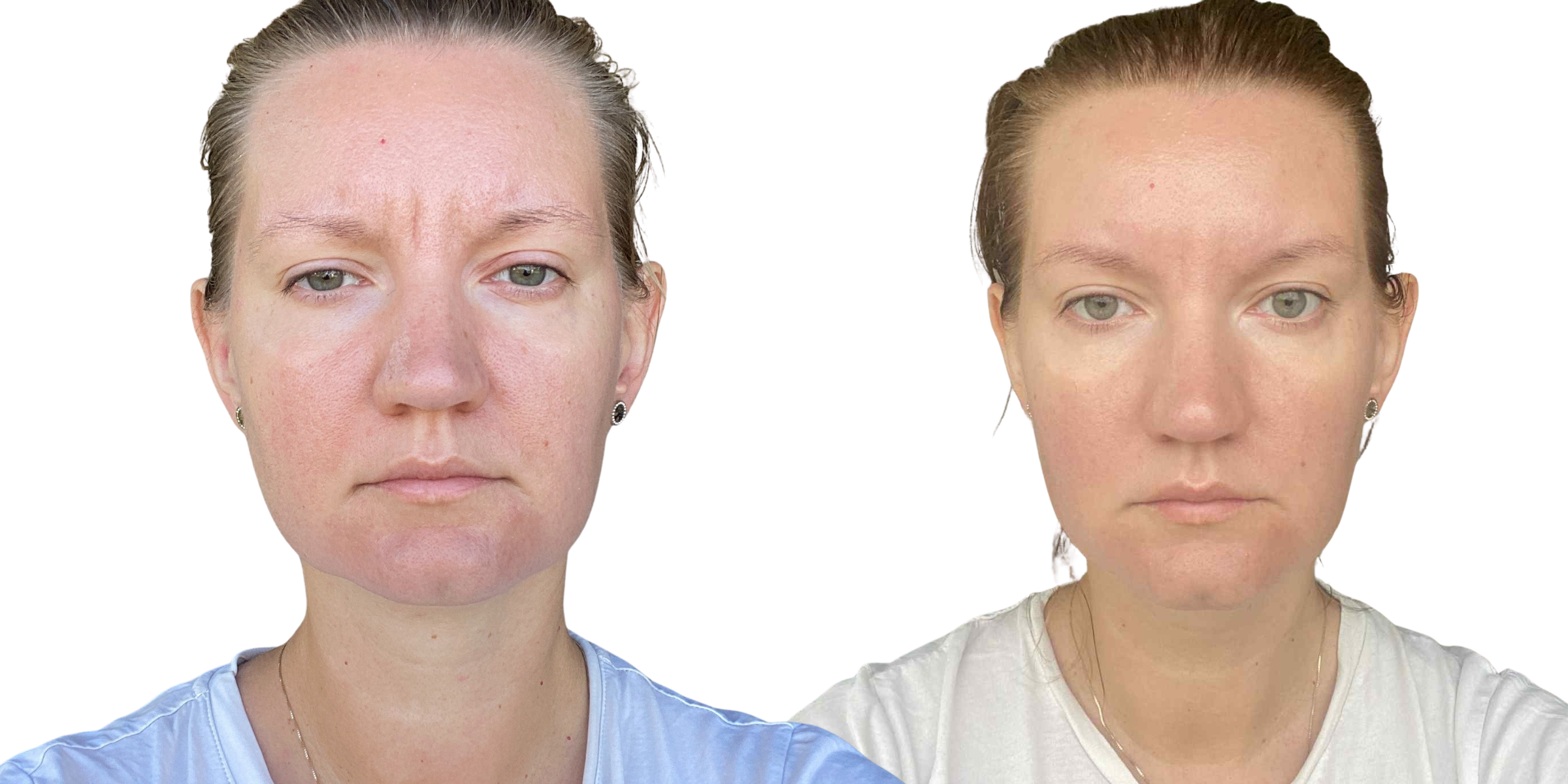 Full Face 14-Day Sculpting Program